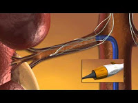 Control Blood Pressure by Bestroying Nerves Terminating in Kidney