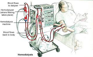 8 Problems to Watch During Dialysis